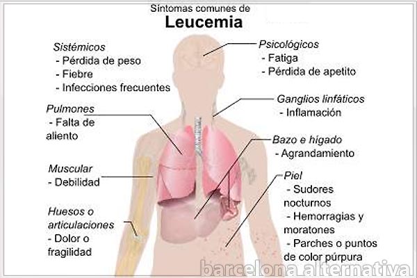 Leucemia: Se diagnostican ocho casos por día • Canal C