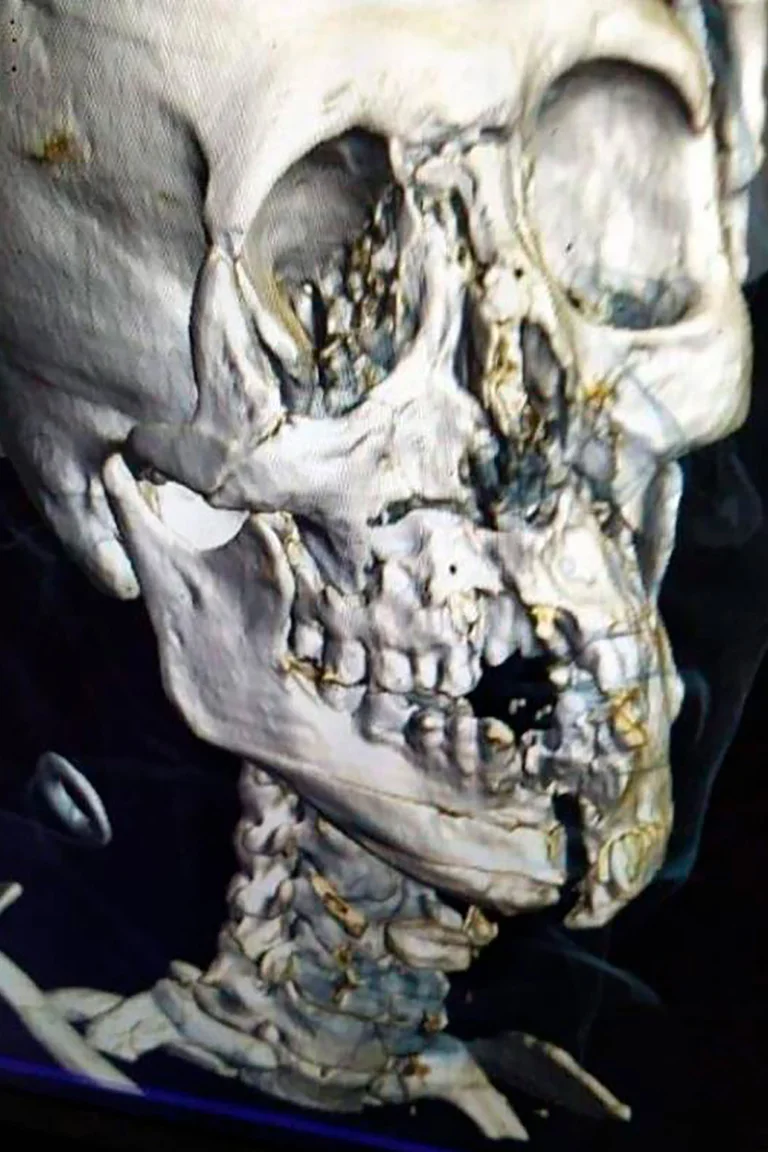 La impactante imagen de cómo le quedó el cráneo al futbolista de Arabia Saudita • Canal C