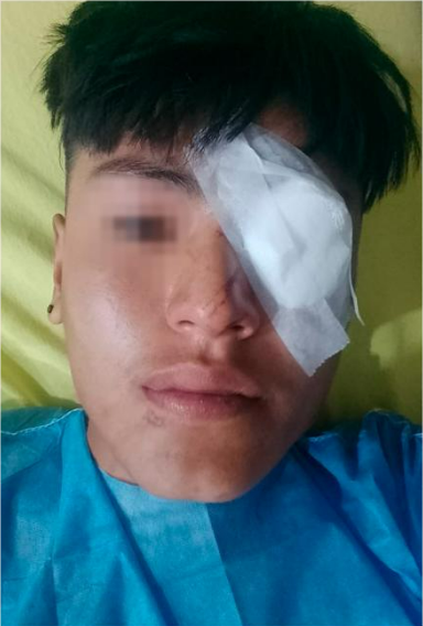 Jujuy: un joven perdió un ojo tras recibir una bala de goma • Canal C